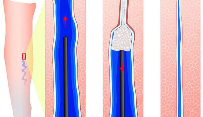 Einführung von Sclerosant in der Sklerotherapie